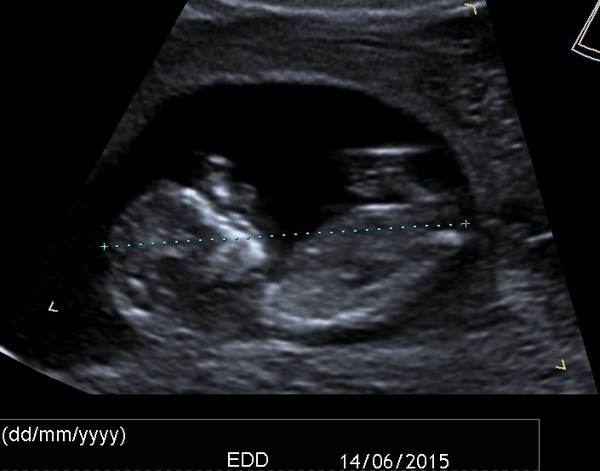 June 2015 - thread 6 - baby kicks and bumps appearing