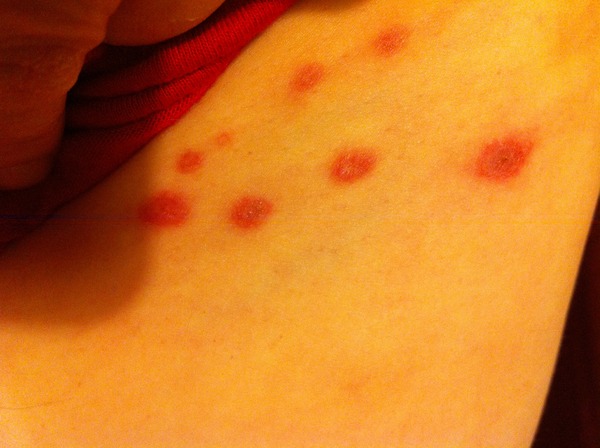 Is it possible to have really mild shingles?