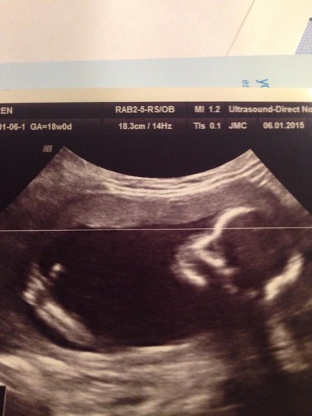 June 2015 - thread 6 - baby kicks and bumps appearing