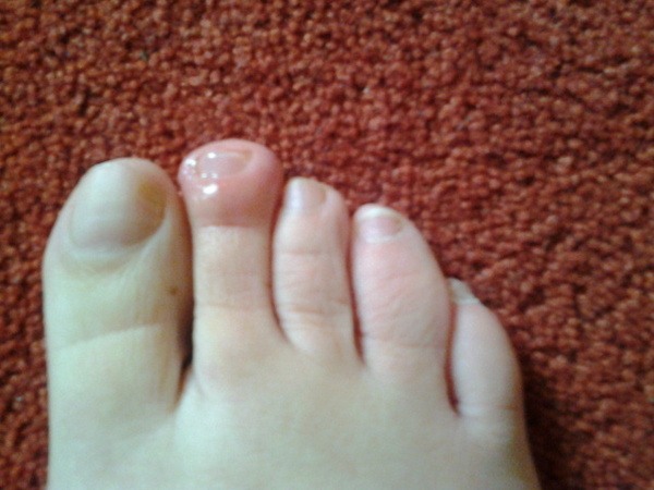 Booked for a pedicure tomorrow but I think I have some kind of infection...