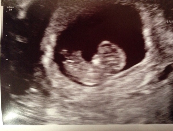 September 2015 (#3) bring on the scans as our waists expand!