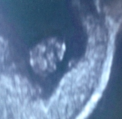 September 2015 (#3) bring on the scans as our waists expand!