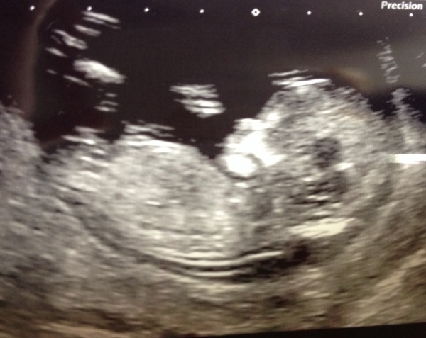 July 2015 - more and more beans are seen on scans