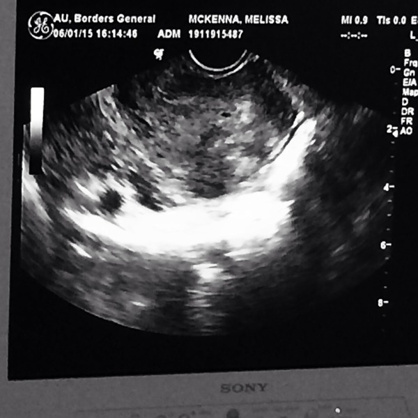 Bloodclot in the womb