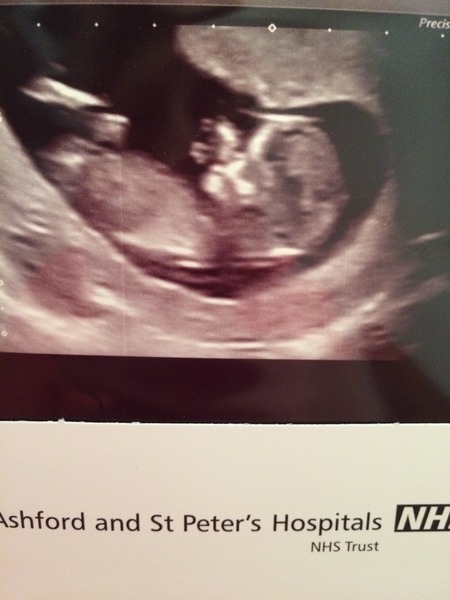 July 2015 - more and more beans are seen on scans