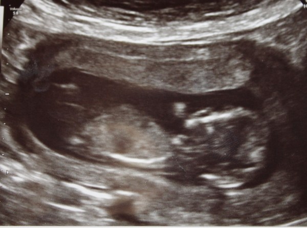 July 2015 - more and more beans are seen on scans