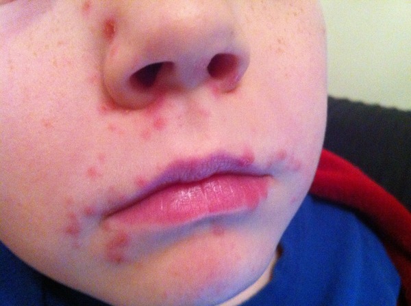 Possible Chickenpox?