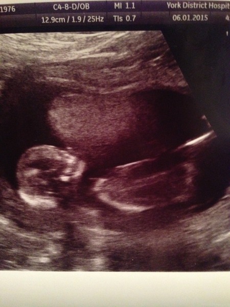 July 2015 - more and more beans are seen on scans