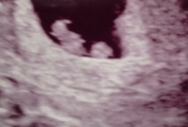 September 2015 (#3) bring on the scans as our waists expand!