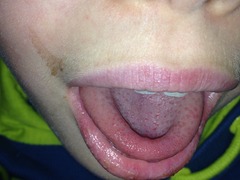 Strawberry tongue