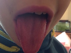 Strawberry tongue