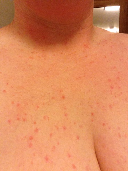 What on earth does DH have if it's not chicken pox??