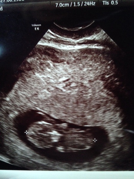 September 2015 (#3) bring on the scans as our waists expand!