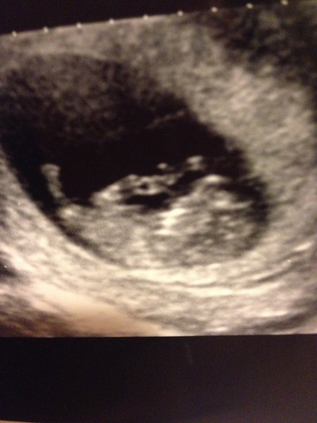 September 2015 (#3) bring on the scans as our waists expand!