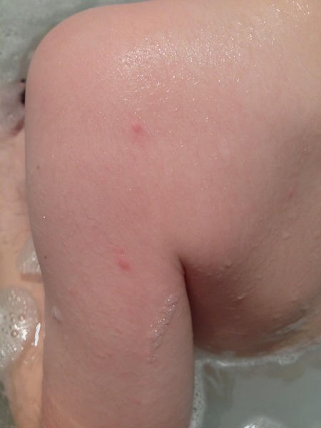 Nightly rash - any idea what it could be?