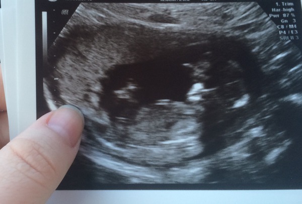 September 2015 (Thread 5) Bring on the scans! :)