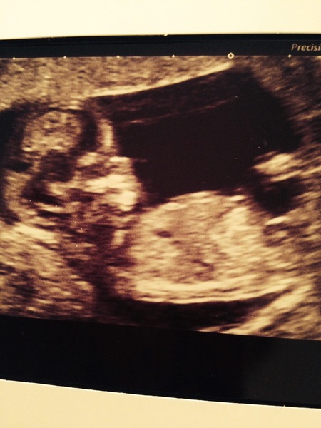 September 2015 (Thread 5) Bring on the scans! :)