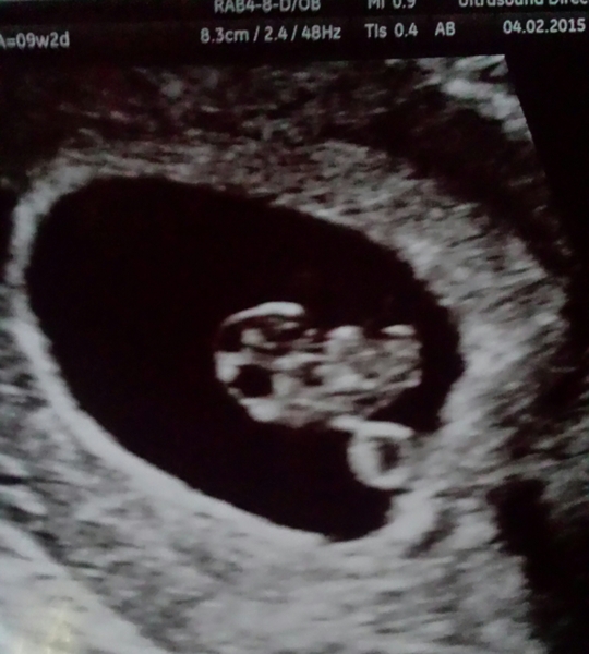 Private early scan - is it worth it?
