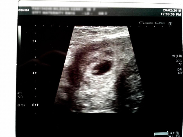 Pregnancy after IVF/Infertility