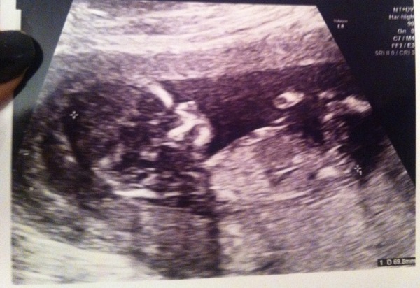 Girl or Boy - calling all nub experts