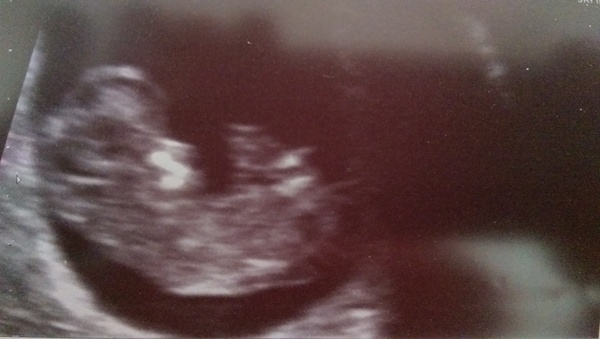 September 2015 (Thread 5) Bring on the scans! :)