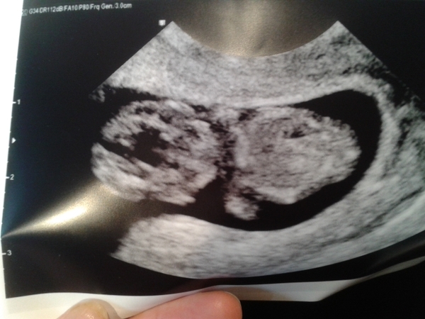 September 2015 (#3) bring on the scans as our waists expand!