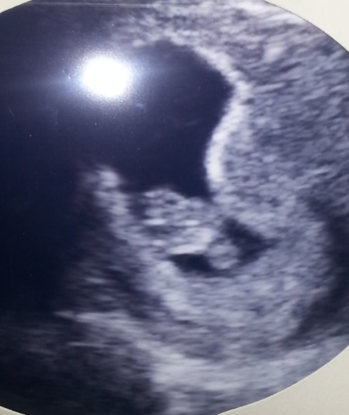 Private early scan - is it worth it?