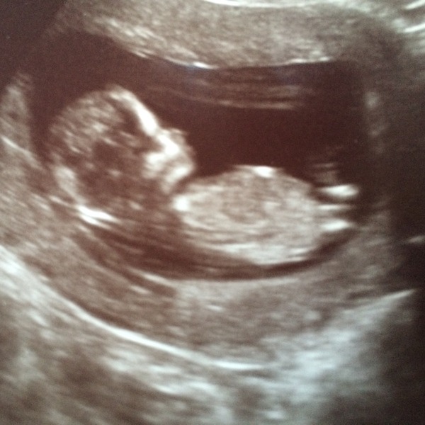 Gender - boy or girl?