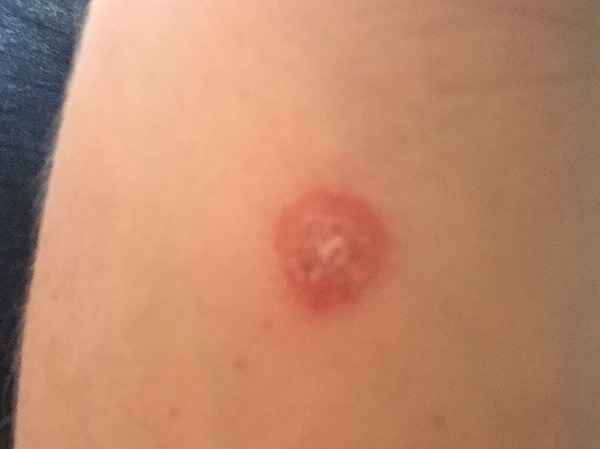 Freckle gone weird