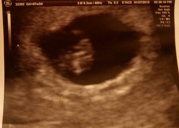 Grab your scans ladies for the...drumroll...Ramzi Placenta Theory!