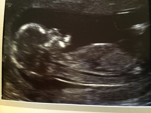 September 2015 (Thread 5) Bring on the scans! :)