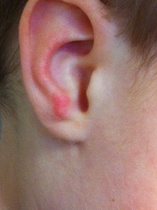 Does anyone know what this spot is on my toddler's ear?