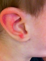 Does anyone know what this spot is on my toddler's ear?