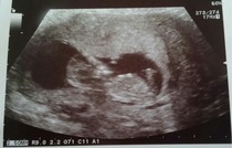 12 week scan report is scaring me - can anyone help interpret?