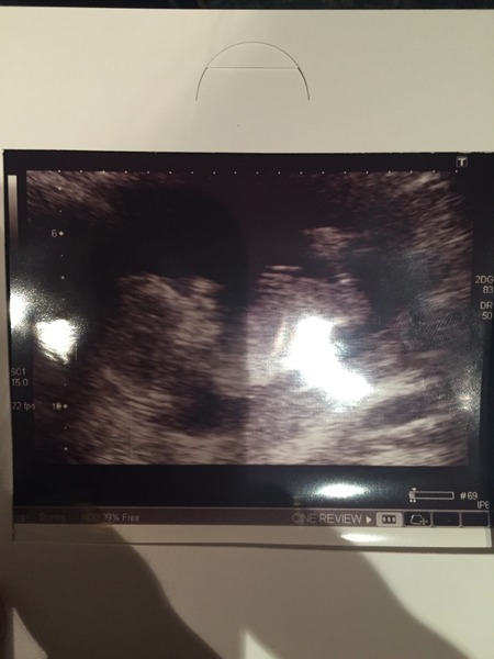 12 week scan pic