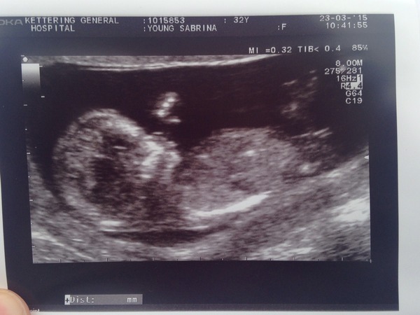 Nub theory, can anyone guess the sex of my baby