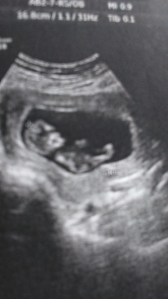 12 week scan pic - can anyone guess the sex?