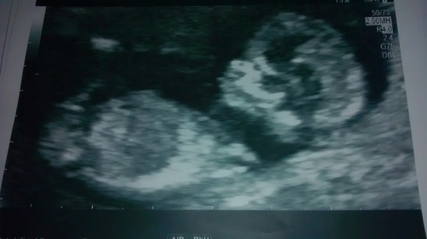 12 week scan pic - boy or girl