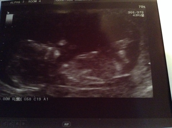 Anyone TTC after vasectomy reversal op?