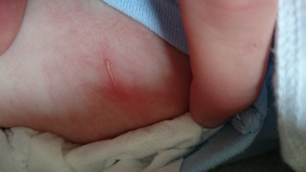 infected pus filled scratch