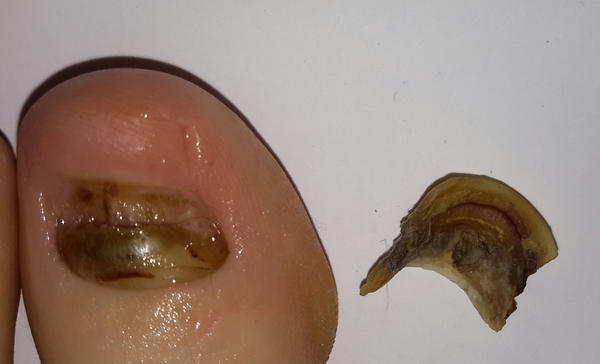 Toenail fallen off - any advice? (klaxon of sorts)