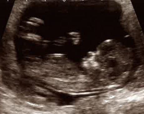 20 week scan Thursday Morning (tomorrow)!!  Last minute guesses please ;-)