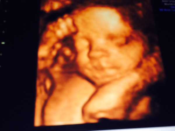 Anyone had a private gender scan?