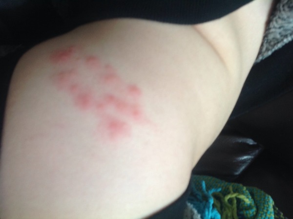 Dd has a lump in her groin and in so much pain she can't walk.