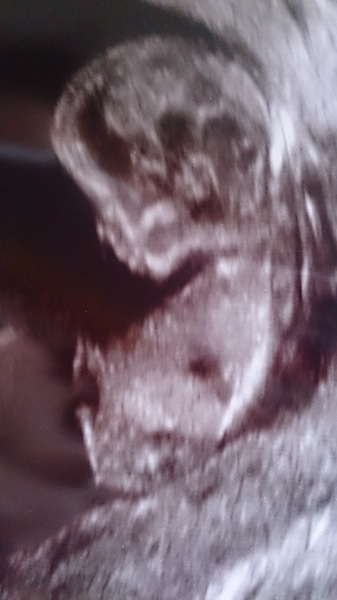 12 week scan