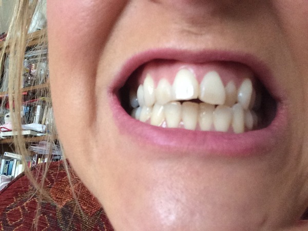 Can I do anything to improve my teeth if I'm scared of veneers?