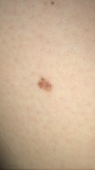 Anyone know about moles?