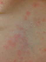 Is this eczema or chicken pox (pics)
