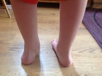 Hypermobile, knocking knees, leg problems.....