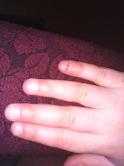 Exposed nail bed - how to look after it?
